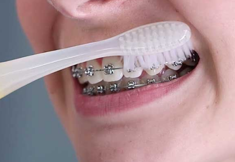 Hướng dẫn cách chăm sóc răng niềng hiệu quả nhất tại nhà